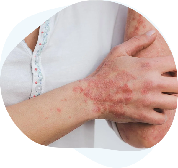 Best Psoriasis Treatment Clinic Psoriasis Treatment in India